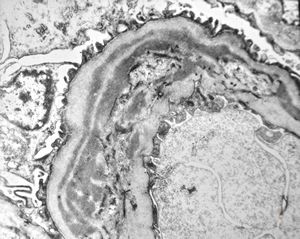 type I membranoproliferative glomerulonephritis